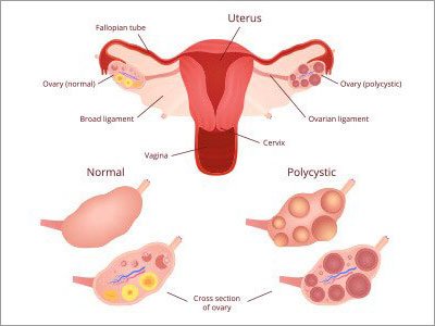 Case of Polycystic Ovarian Disease treated with Nux Vomica